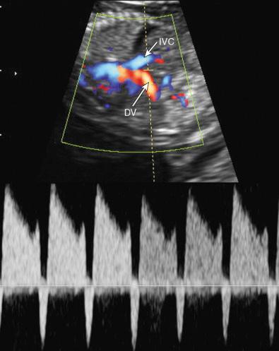 FIG 13-8, Reversed a wave in the ductus venosus in a fetus with trisomy 18 and tricuspid atresia. DV, ductus venosus; IVC, inferior vena cava.