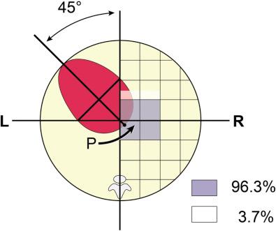 FIG 13-9, Fetal cardiac axis and position. The mean cardiac axis is 45 degrees (2 SD = 20 degrees, range 22-75 degrees). A line through the interventricular axis is extended to the posterior border of the heart to produce point P, the location of which can be used to define cardiac position. The percentages represent the proportion of time point “P” is in the indicated location. L, left; R, right; SD, standard deviation.