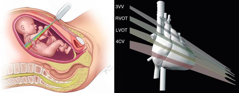 FIG 13-10, Basic sonographic approach for the midtrimester fetal cardiac screening examination. Cephalad sweep of an ultrasound transducer toward the fetal head is used to visualize a four-chamber view (4CV), left ventricular outflow tract (LVOT), right ventricular outflow tract (RVOT), and three-vessel view (3VV), respectively.