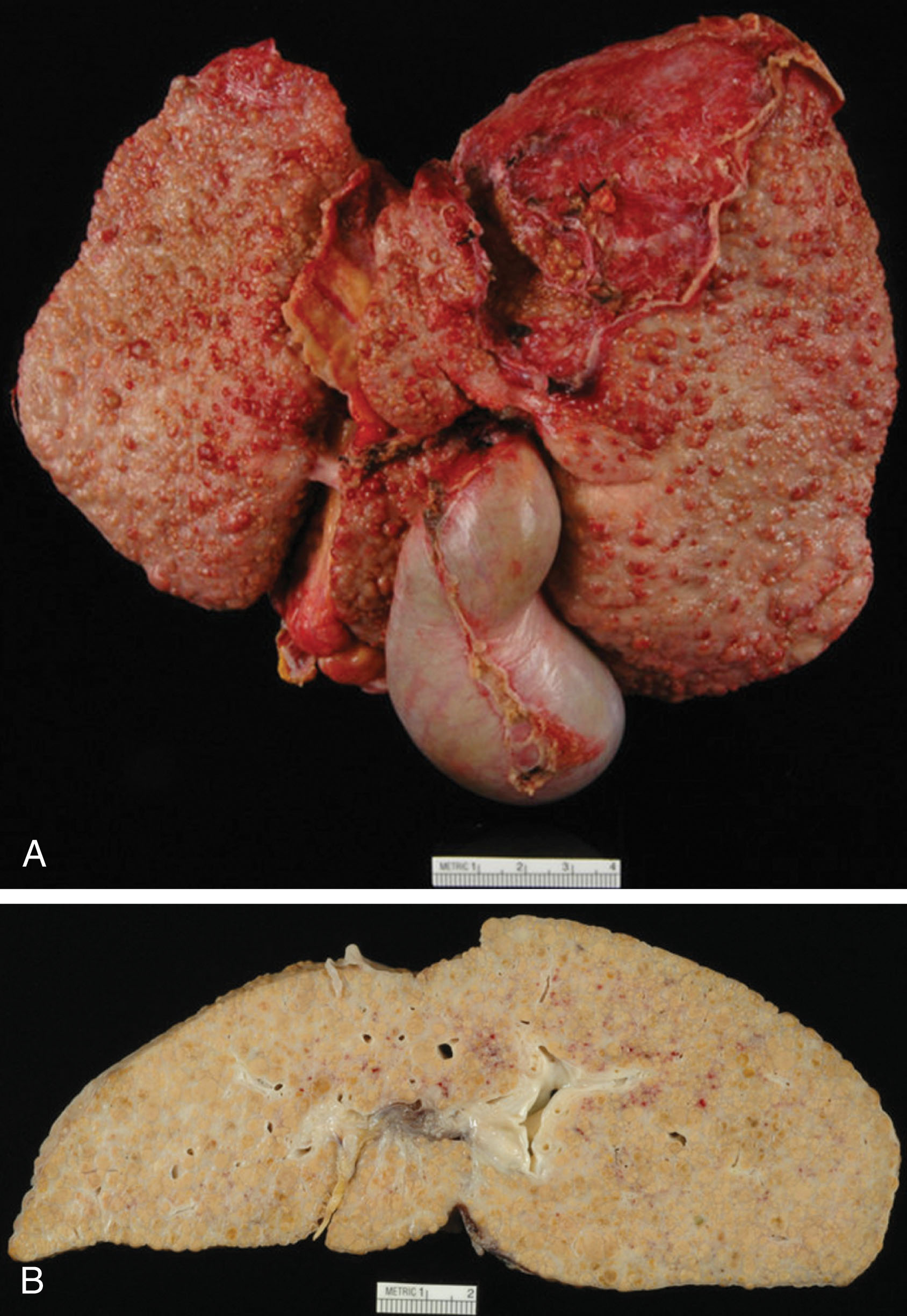 Fig. 20.1, Pathology liver specimen of cirrhosis due to alcoholic liver disease.