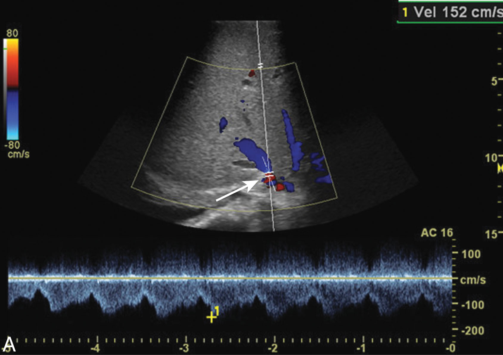 Fig. 20.11, Hepatic vein stenosis and thrombosis.