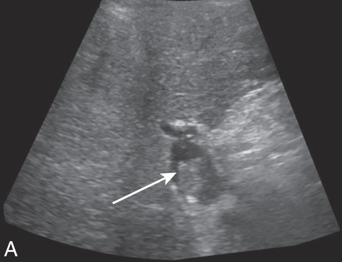 Fig. 20.12, Immediate postoperative acute portal vein occlusive thrombus.