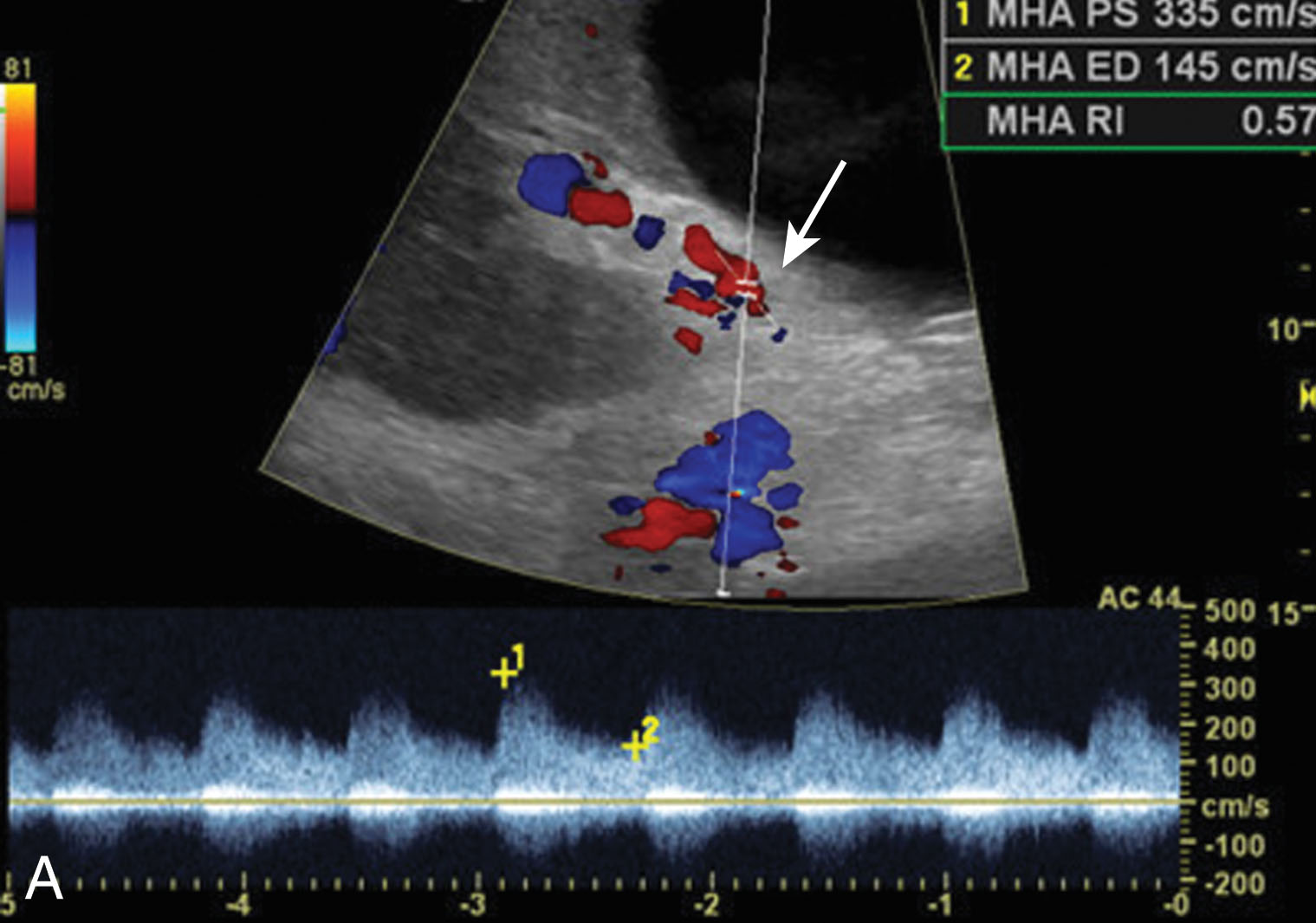 Fig. 20.14, Hepatic artery stenosis.