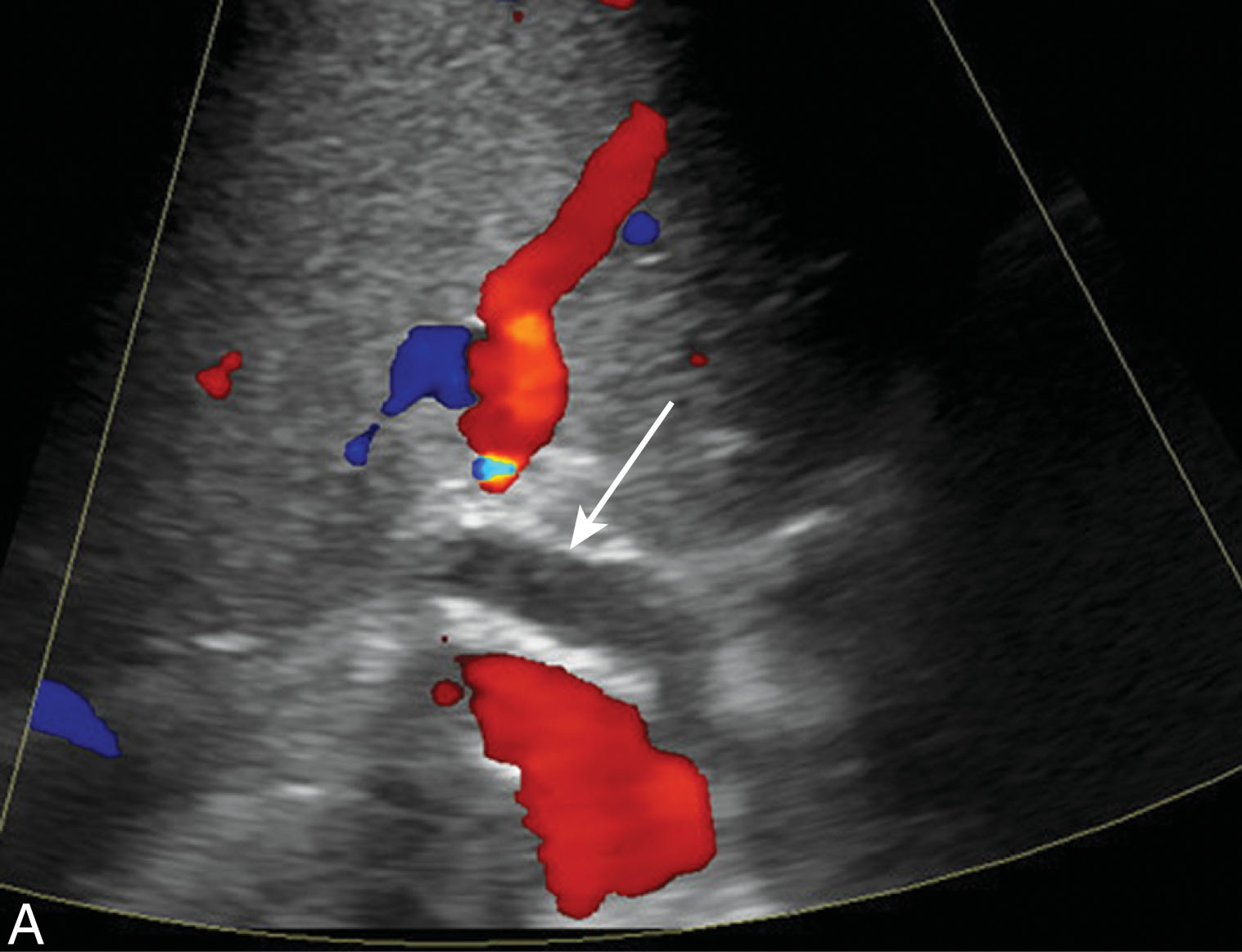 Fig. 20.15, Acute hepatic artery thrombosis.