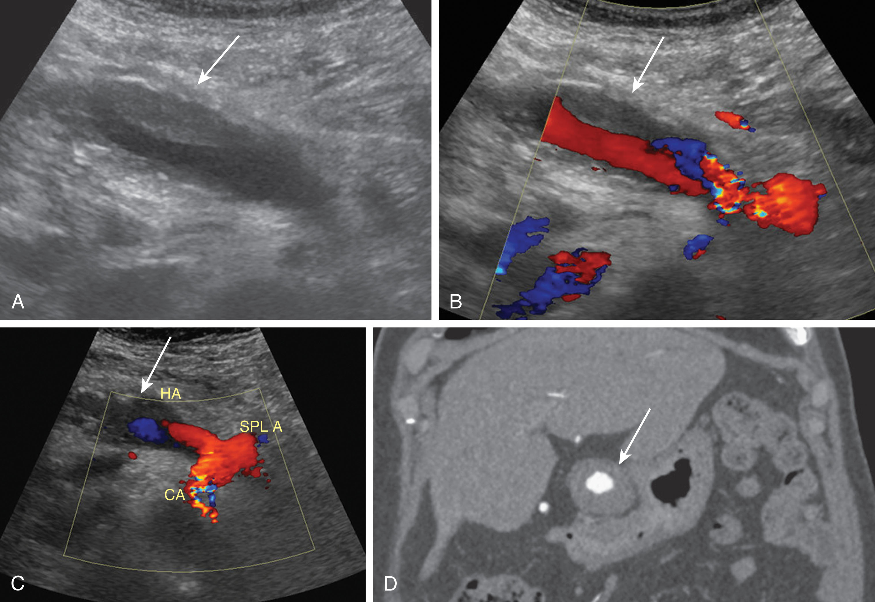 Fig. 20.17, Hepatic artery pseudoaneurysm.