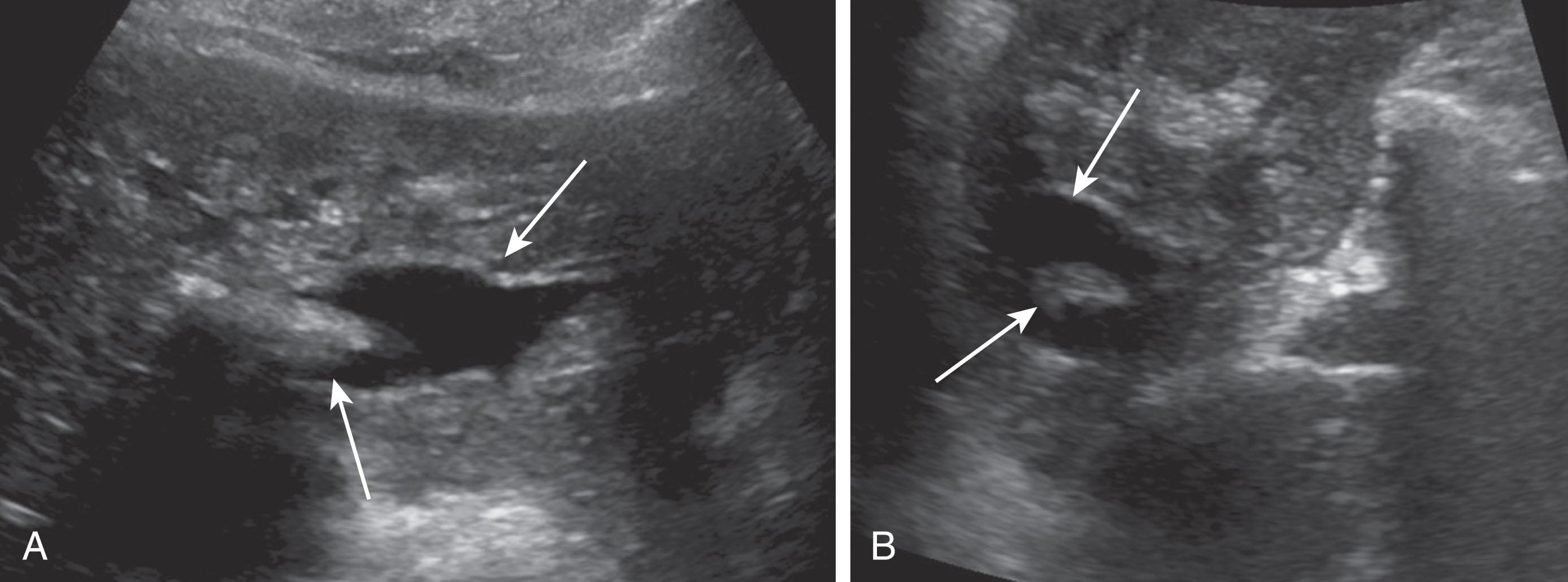 Fig. 20.19, Intrahepatic ductal dilation with stones.