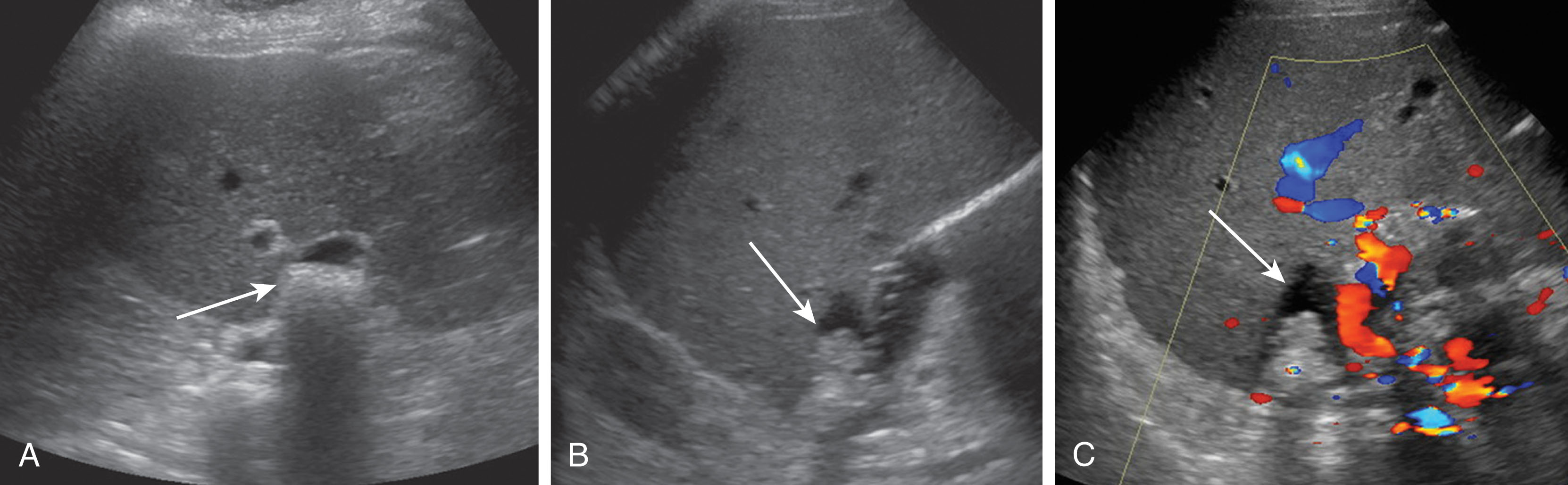 Fig. 20.20, Cystic duct remnant with stones and debris.