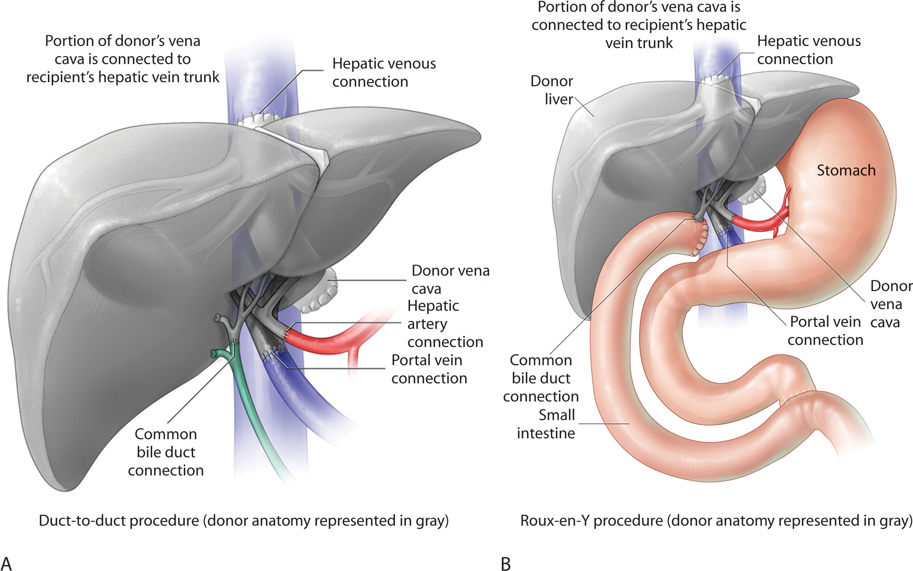 Fig. 20.2, Anastomosis sites of cadaveric liver transplant.