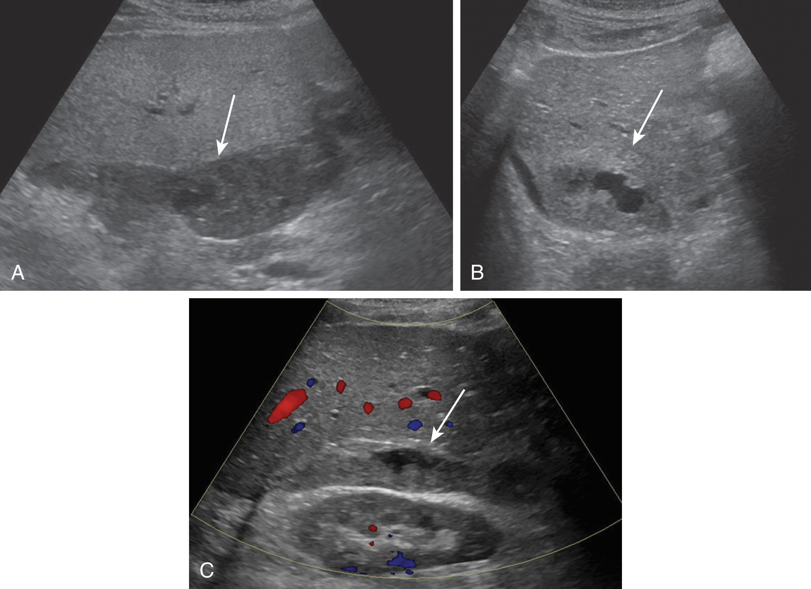 Fig. 20.21, Postoperative hematoma.