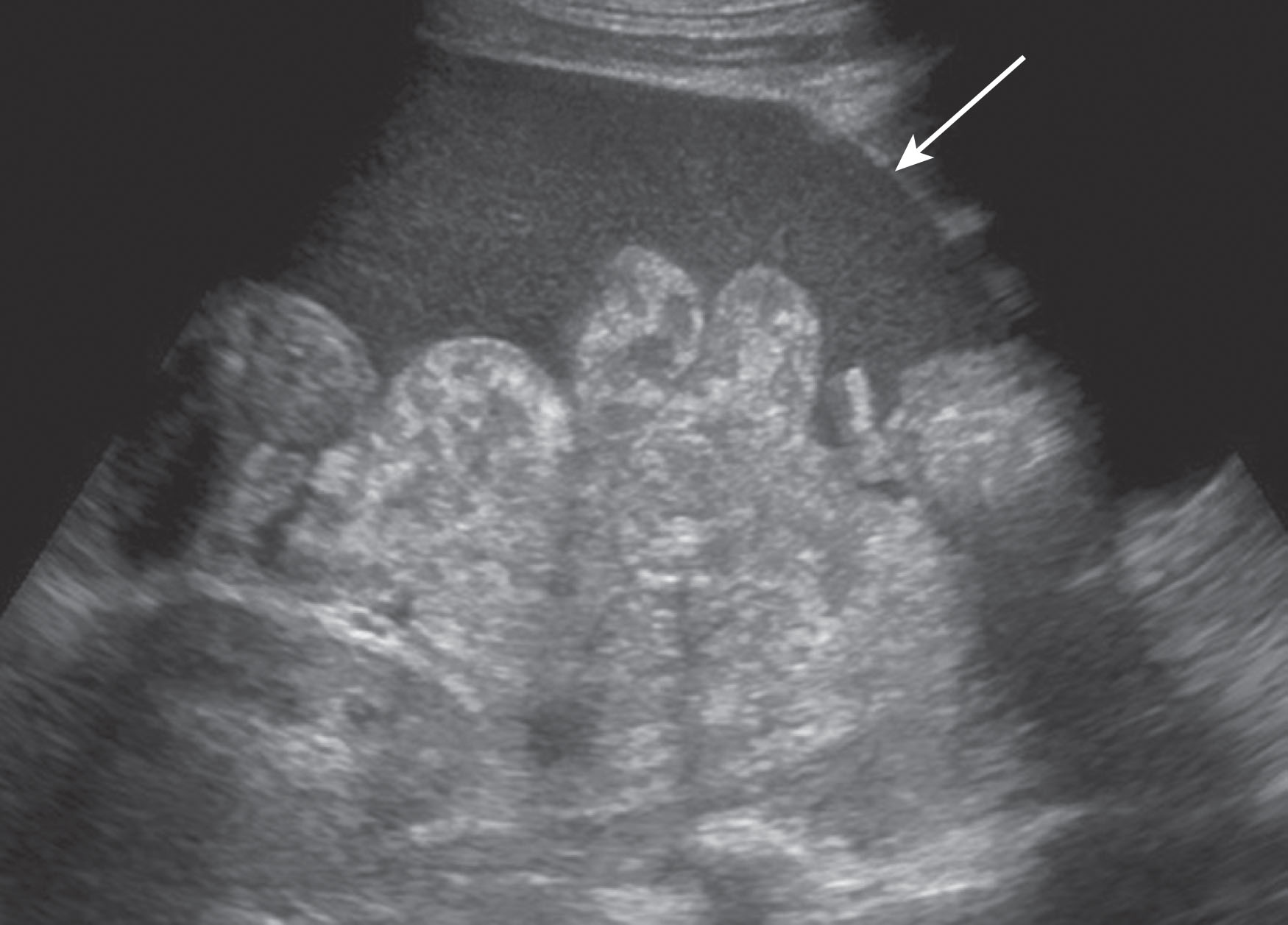 Fig. 20.24, Debris-filled ascites due to hemorrhage on gray-scale ultrasound.