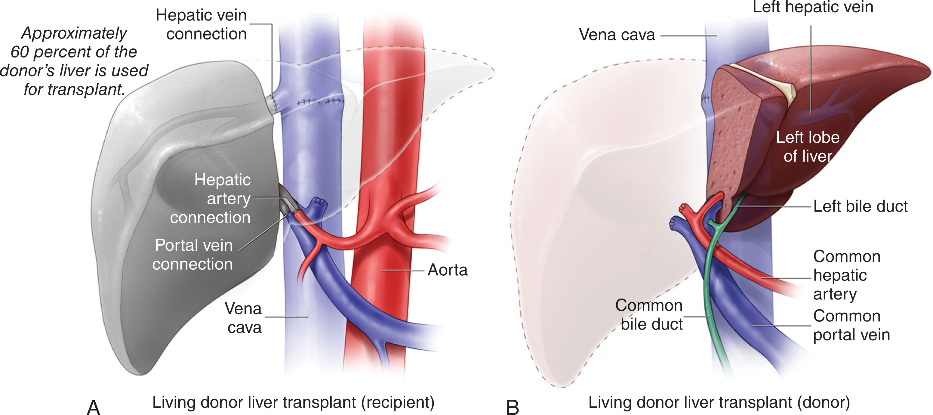 Fig. 20.3, Anastomosis sites of living donor liver transplant.