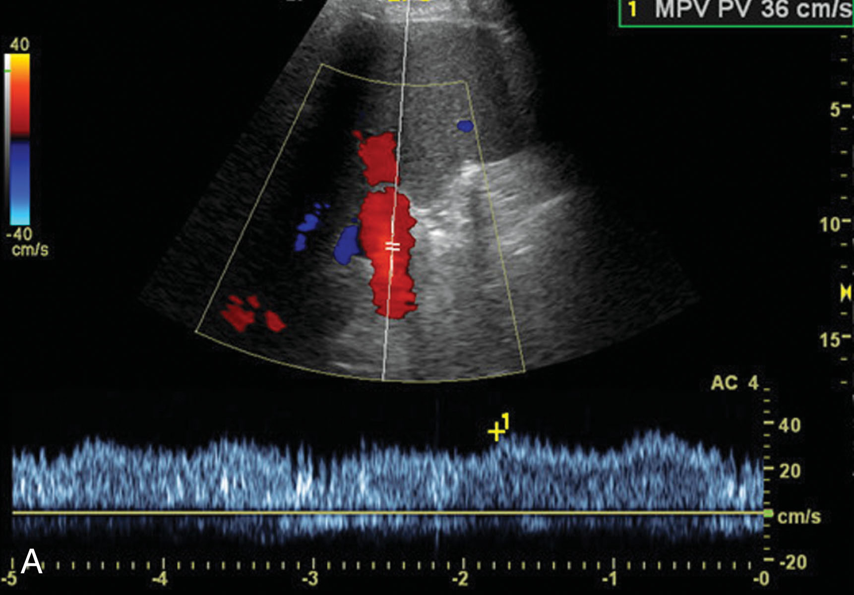 Fig. 20.5, Normal liver Doppler.