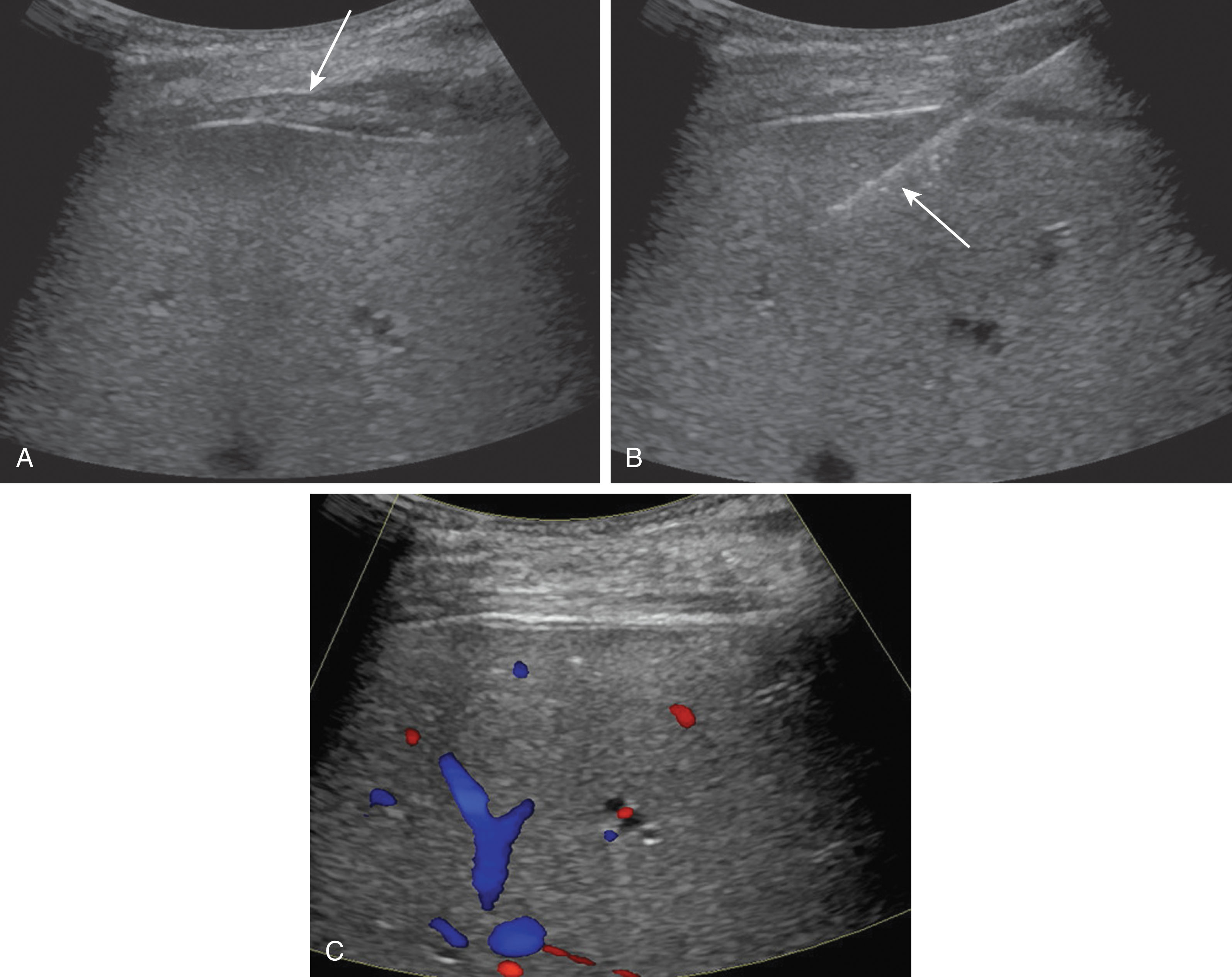 Fig. 20.7, Normal routine liver biopsy.