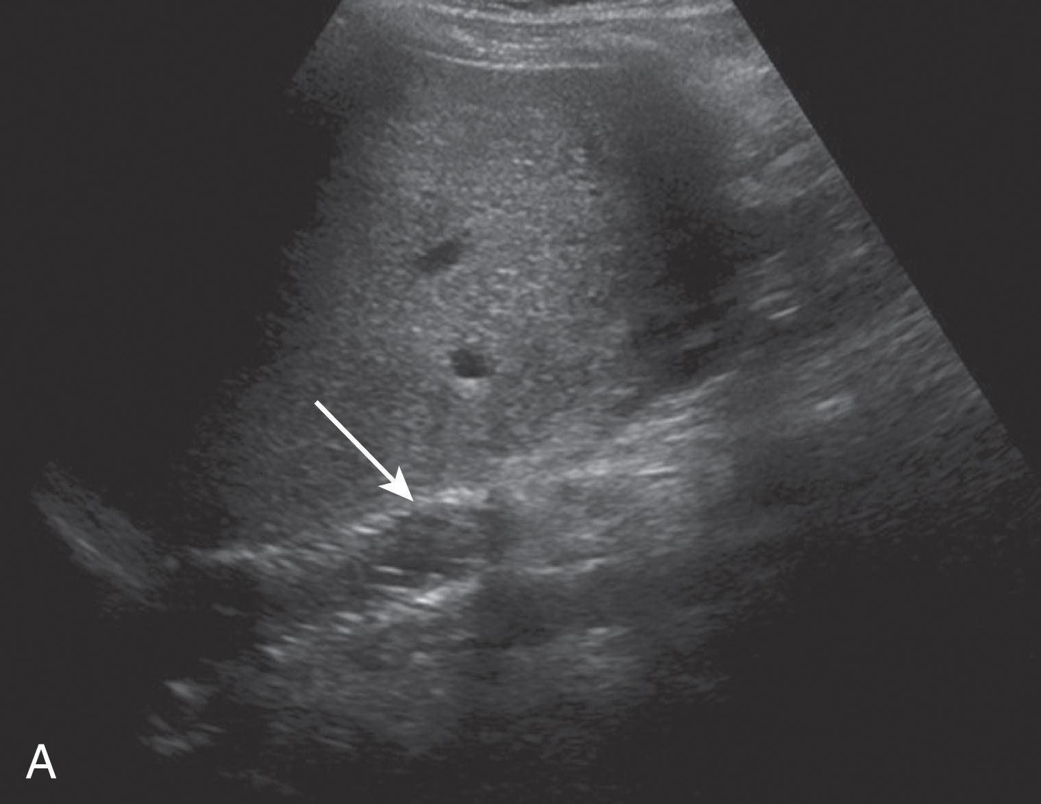 Fig. 20.10, Inferior vena cava (IVC) stenosis and stent placement.