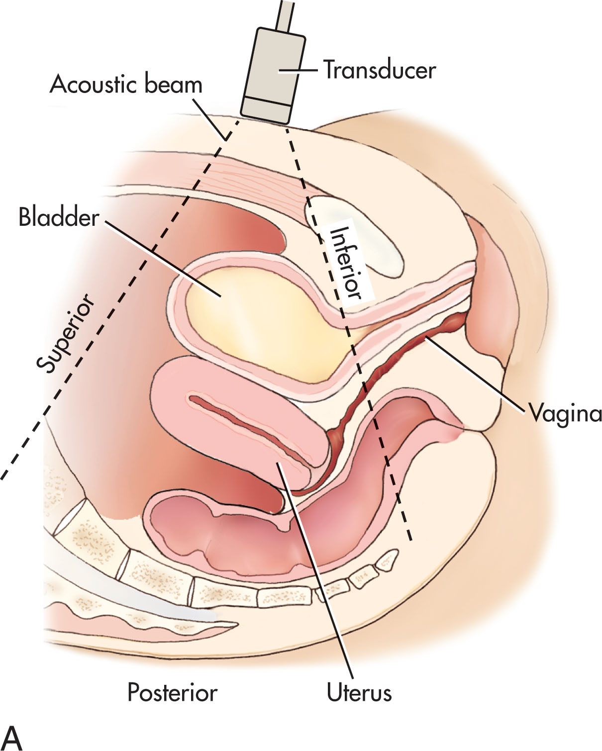 Fig. 42.1, (A) Sagittal plane/transabdominal approach illustrates how transabdominal pelvic sonography may be performed from an anterior approach using the fully distended urinary bladder as the acoustic window. (B) Transverse plane is 90 degrees to the longitudinal plane. The right of the patient is located on the left side of the image. (C) Transvaginal sagittal plane. The notch of the transducer is along the top surface of the handle, so the beam is projected in the midline anteroposterior aspect of the body. (D) Transvaginal coronal plane. The notch of the transducer is rotated toward the sonographer so the beam may image the uterus in a coronal view.