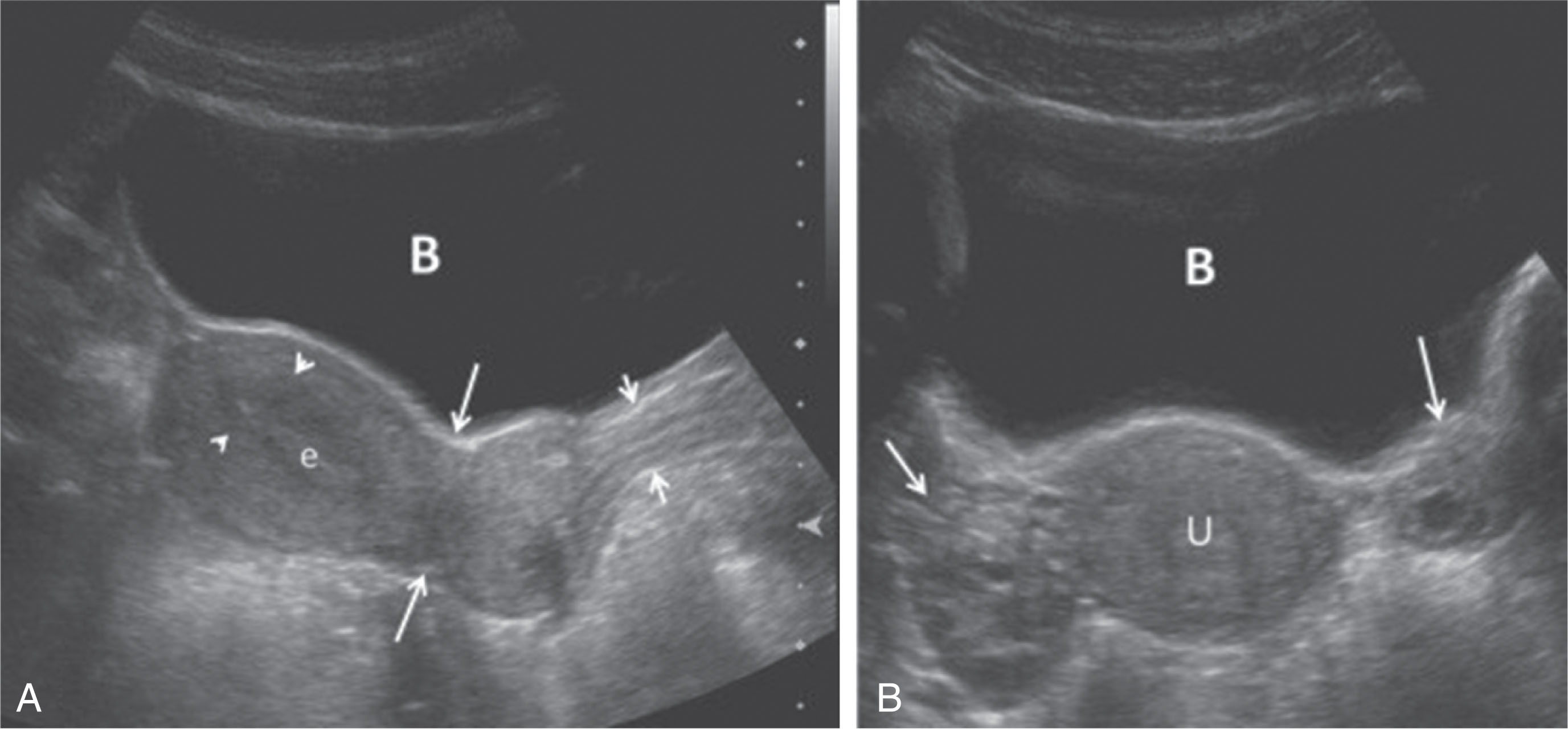 Fig. 42.2, Transabdominal sagittal (A) and transverse (B) images. The distended bladder (B) also becomes an acoustic window to view pelvic anatomy and pathology and serves as a “cystic” reference. The bladder is considered optimally full when it covers the fundus of the normal-sized uterus (U). (C) The bladder is distended but does not cover the fundus of the uterus. (D) Overdistention of the bladder may compromise the sonographic evaluation and compress, distort, and displace anatomy. e , Endometrium.