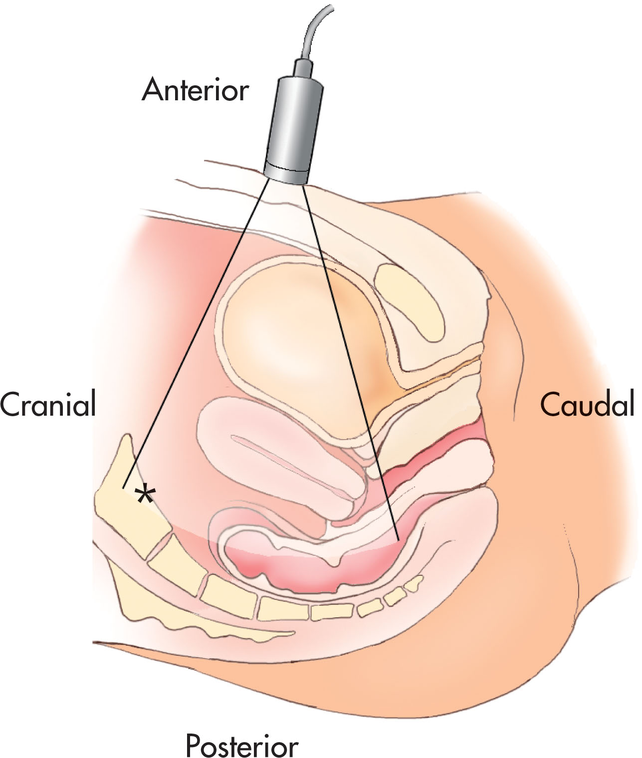 Fig. 42.3, The long axis may not be in a true anatomic sagittal plane because the uterus can normally deviate toward either the right or the left. A somewhat oblique angulation through the distended bladder may be necessary to visualize the entire uterus and cervix.