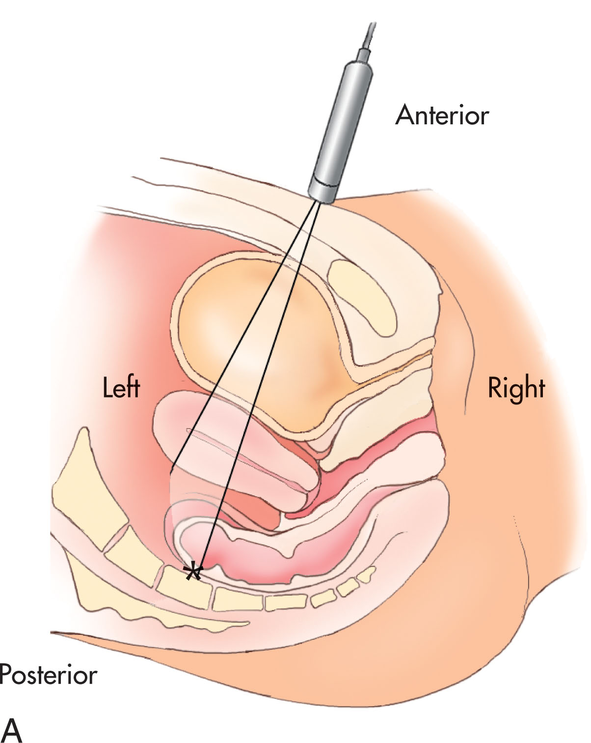 Fig. 42.4, (A) Identify the true sagittal plane of the uterus and cervix, then rotate the transducer 90 degrees to obtain the axial or axial-coronal (transverse) images. Angulation from the contralateral side or direct visualization may help to image the adnexa. Anatomic correlation is correct for axial scans when the left side of the screen correlates with the right side of the patient. (B) Transabdominal image of the distended urinary bladder and uterus. Note the bright endometrial cavity.