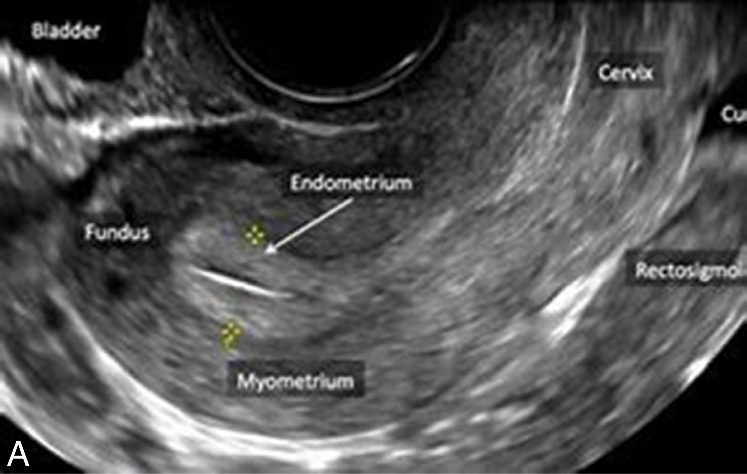 Fig. 42.6, (A) The sagittal scan of the uterus should include the cervix, body, and fundus. (B) The long axis of the uterus is measured from the cervix to the fundus of the uterus. (C) The endometrial cavity should be measured.