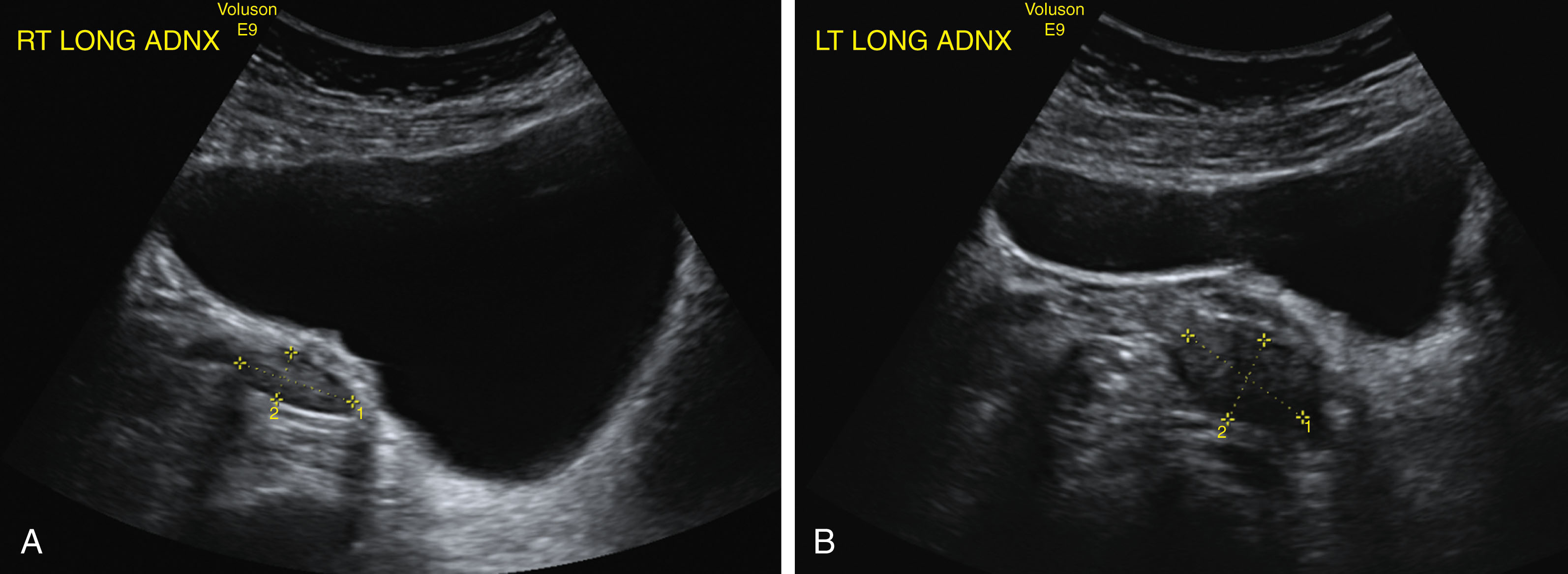 Fig. 42.7, Sagittal image to the right of midline shows the bladder with the right ovary (A) and left ovary (B) posterior. The ovarian length and depth are measured. (C) Sagittal image to the left of midline shows the left ovary posterior to the urinary bladder.