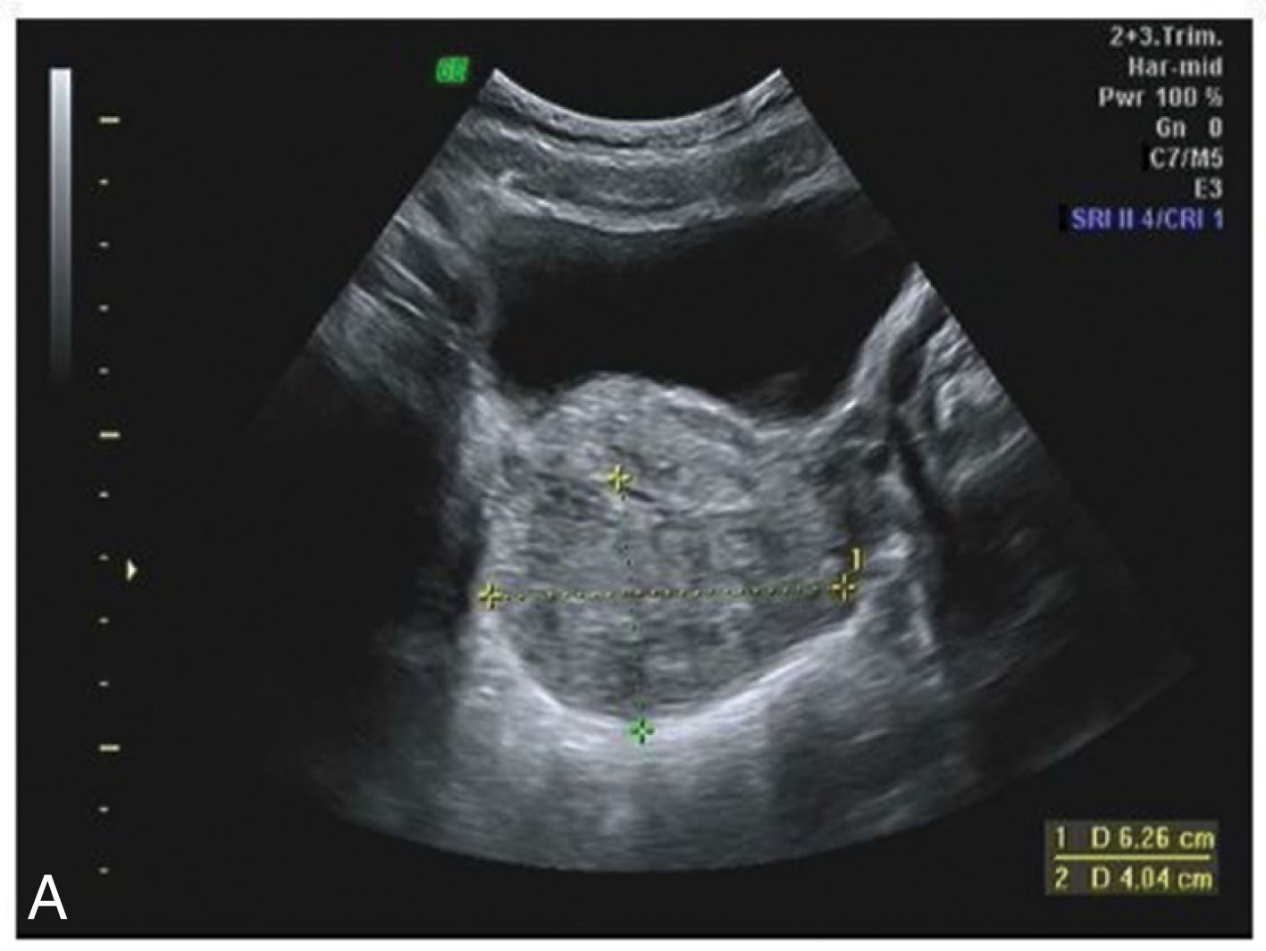 Fig. 42.8, (A) Transabdominal approach to transverse images of the distended urinary bladder and uterus. The measurement is made of the width and depth of the uterus. (B) Transverse image of the ovaries (long arrow) and uterus (arrowhead) .