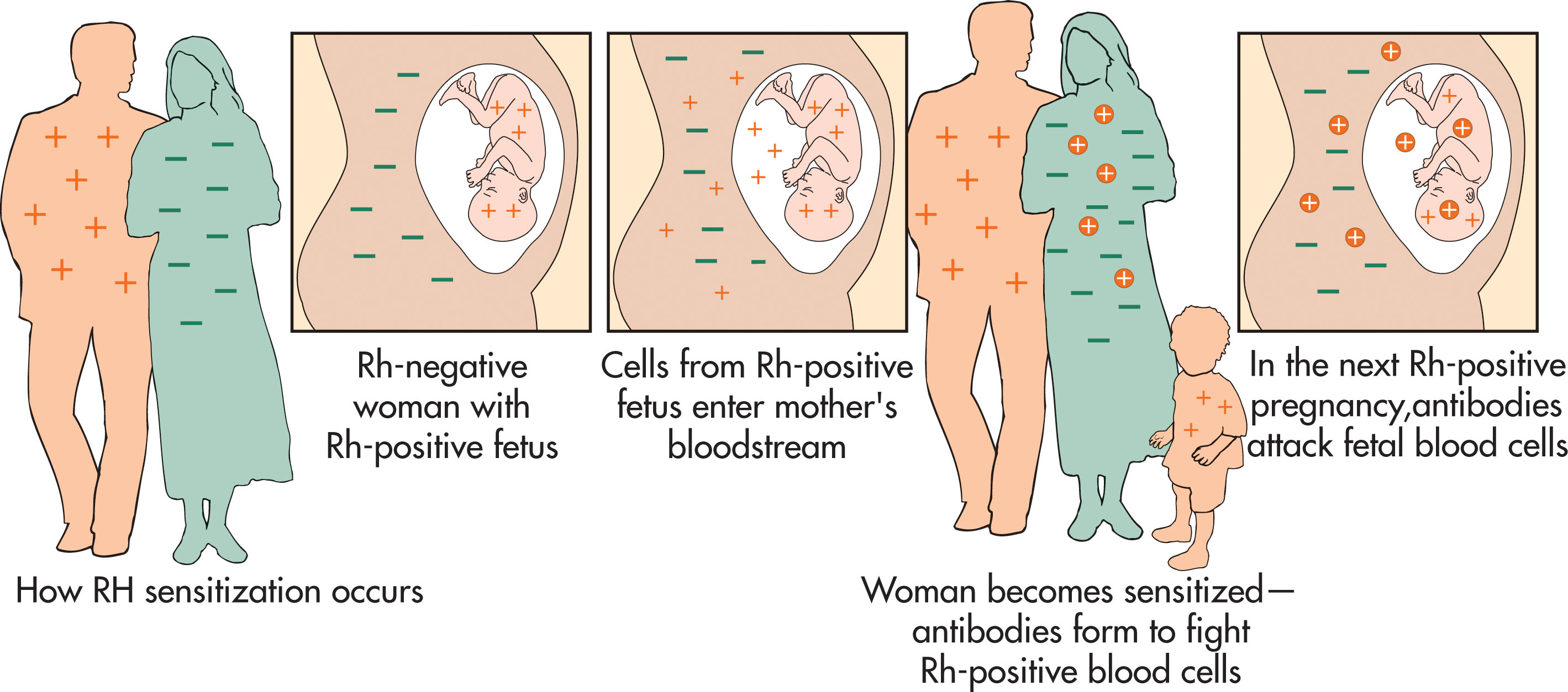 Fig. 54.1, The concept of Rh sensitization.