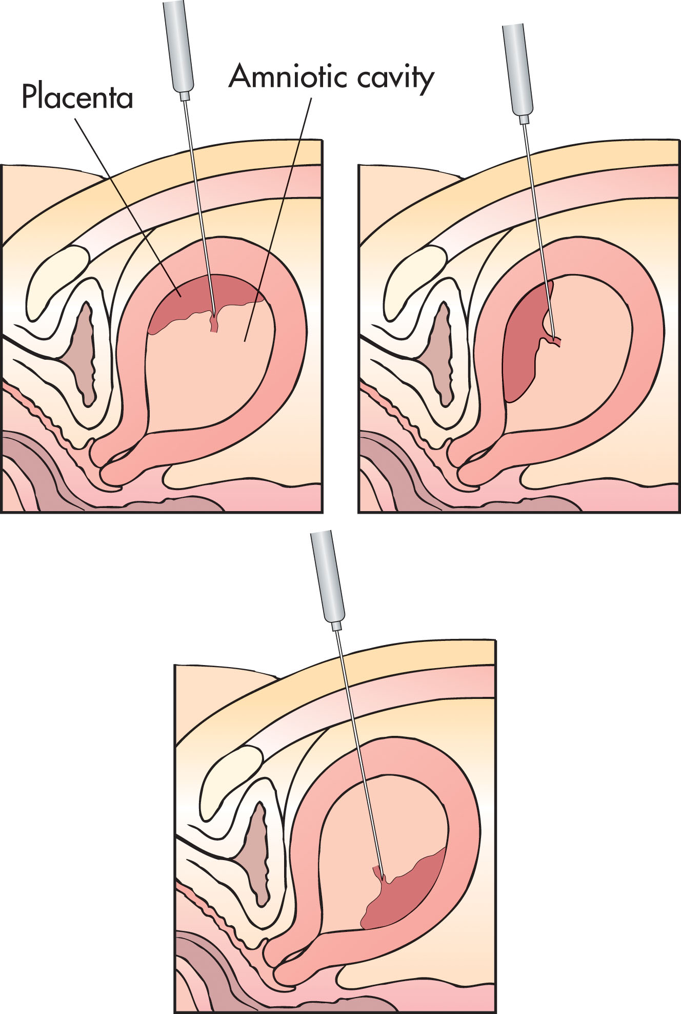 Fig. 54.11, Possible needle paths in cordocentesis depending on the placental position.