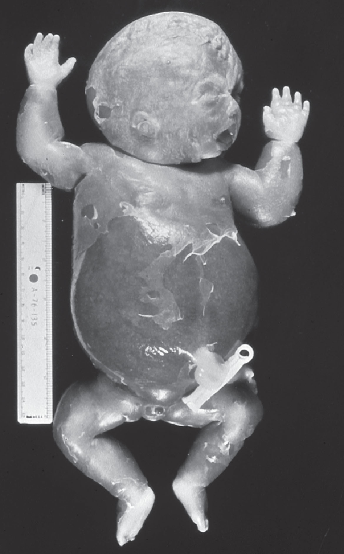 Fig. 54.2, Hydropic, Rh-sensitized fetal demise.