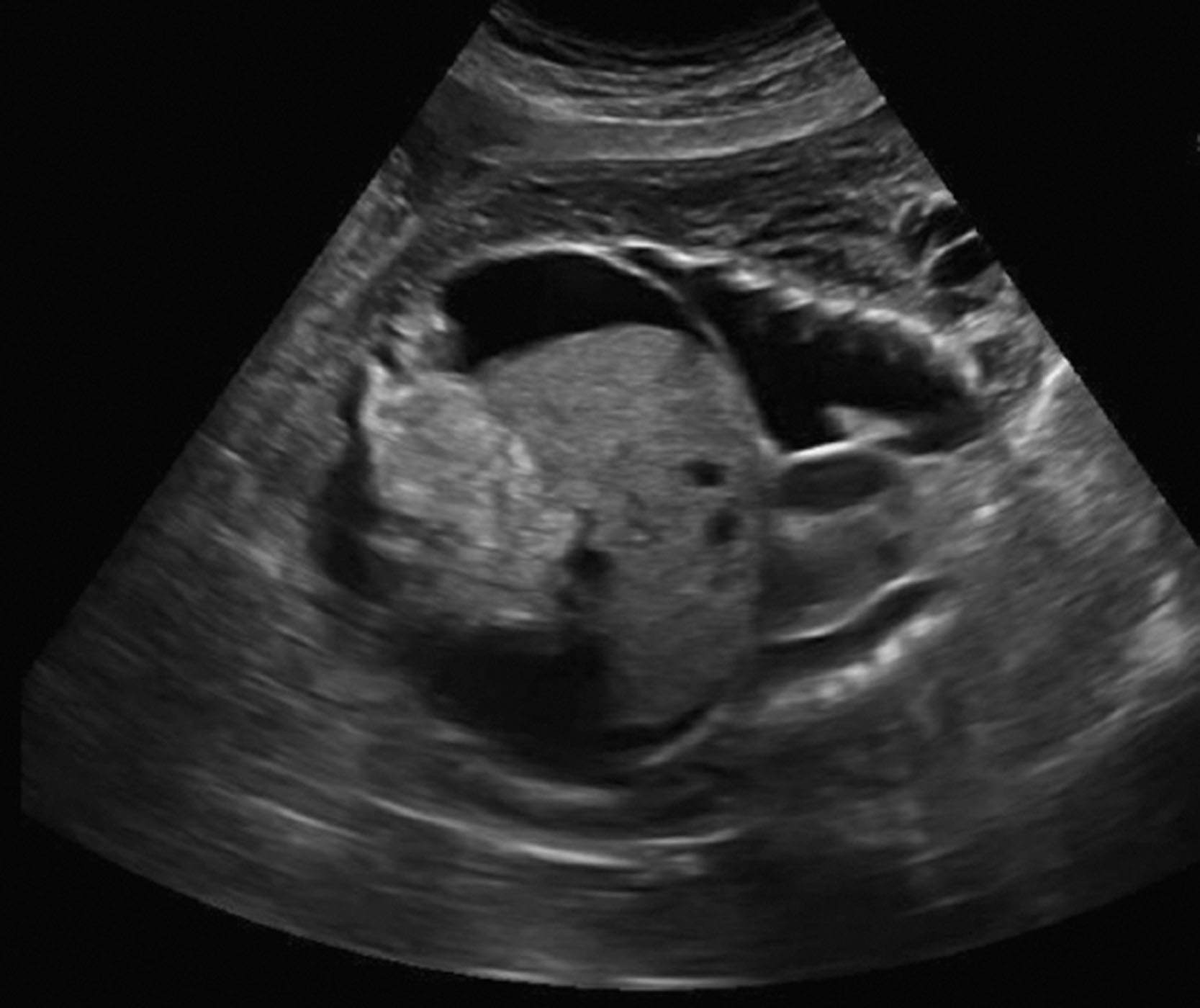 Fig. 54.5, Coronal view of the fetal chest and abdomen with pleural effusion and ascites.