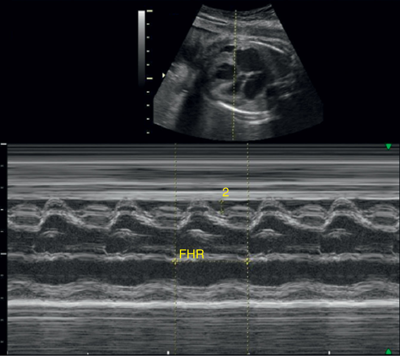 Fig. 54.6, Two-dimensional and M-mode image demonstrating a pericardial effusion.