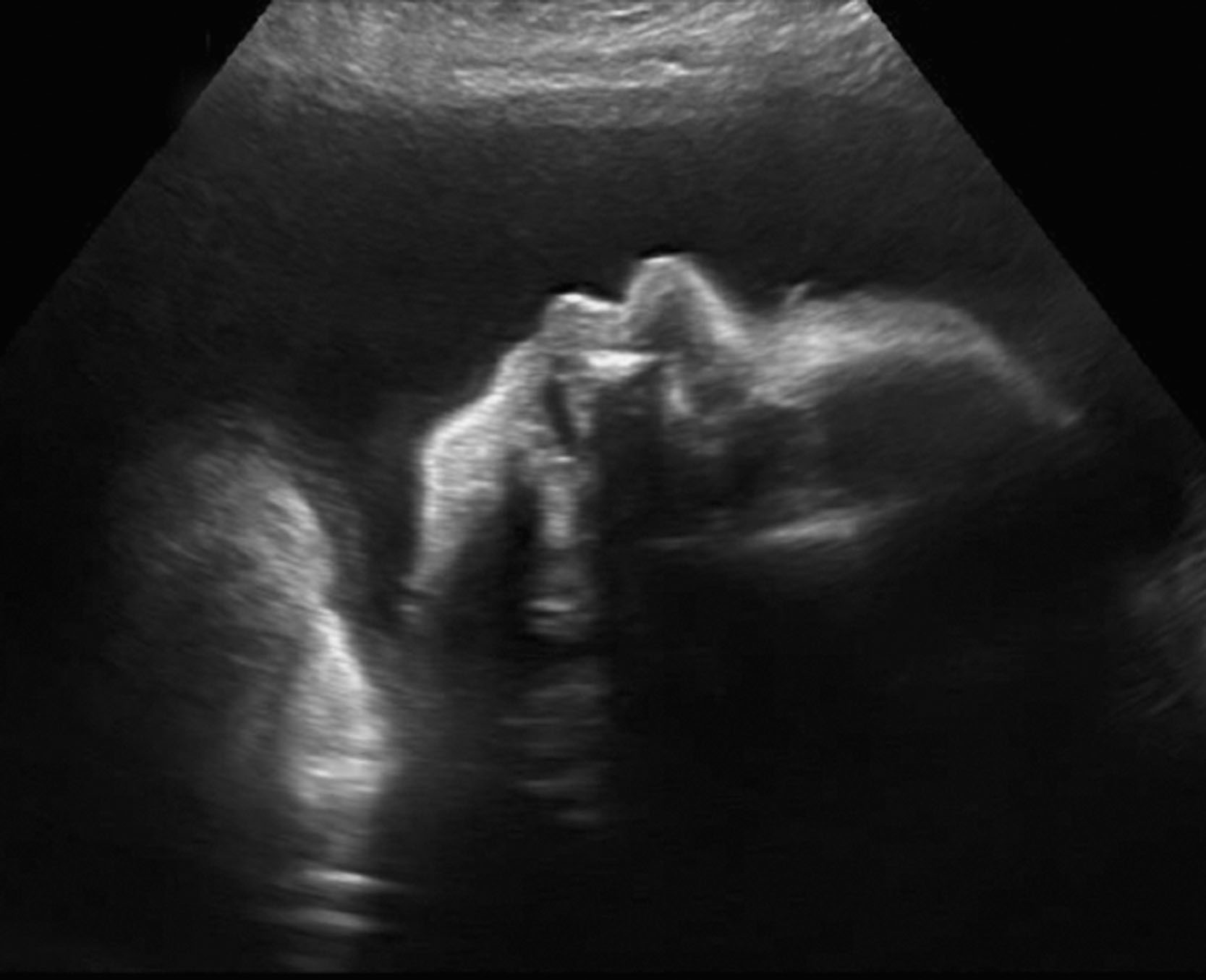 Fig. 54.7, Fetal profile and polyhydramnios.