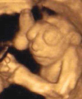 • Fig. 28.12, Three-dimensional image of a fetus with anencephaly.