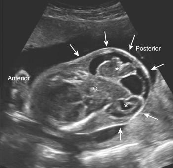 • Fig. 28.13, Large encephalocele (arrows) containing the midbrain ( ° ) and the occipital lobes (asterisk) on the axial plane.