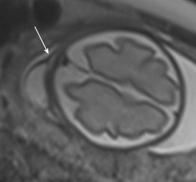 • Fig. 28.14, Axial T2 half-Fourier acquisition single-shot turbo spin-echo (HASTE) image of the brain at 27 weeks and 4 days’ gestation. The small cystic structure in the left parietal area with tapering towards the bone (arrow) suggests a connection with the subarachnoid space: a small encephalocele.