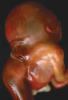 • Fig. 28.15, Cervical rachischisis with hyperextension of the fetal head as seen in iniencephaly. However, iniencephaly is a closed spina lesion.