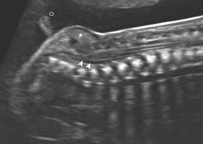 • Fig. 28.19, Occult spina bifida with myelolipoma (asterisk) and tethering of the spinal cord (arrowheads). Notice the small skin appendage (°) .