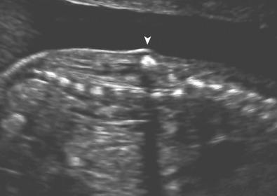 • Fig. 28.20, Diastematomyelia is a closed spinal defect characterised by diplomyelia and a bony spur (arrowhead) .