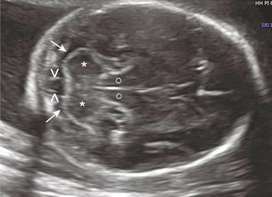 • Fig. 28.2, Axial view through the posterior fossa, illustrating the cerebellum (asterisk) , cisterna magna (arrow) , remnants of the Blake pouch (^) and cerebral peduncles (°).