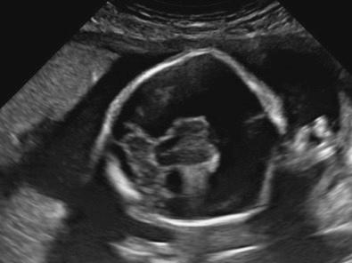 • Fig. 28.21, In alobar holoprosencephaly, the prosencephalic vesicle persists as a large single brain vesicle, overlying the fused thalami.