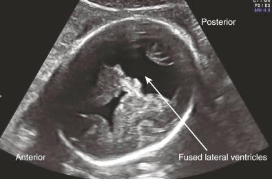 • Fig. 28.22, Interhemispheric holoprosencephaly.