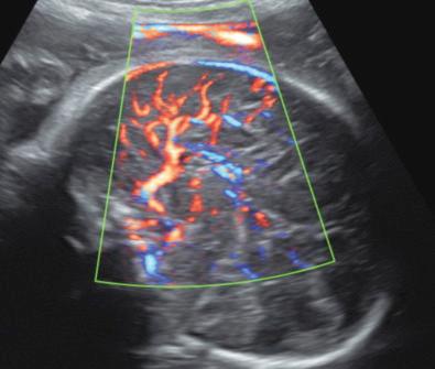 • Fig. 28.24, Abnormal irregular radial vascularisation pattern of the pericallosal artery in complete absence of the corpus callosum.