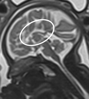 • Fig. 28.25, Sagittal T2 HASTE image of the brain in a fetus at 31 weeks. Absence of the corpus callosum with visualisation of the fornices (circle) and typical sunburst radiation of the gyri.