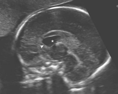 • Fig. 28.26, Partial agenesis of the corpus callosum: the rostrum and genu are absent (arrowhead) . Note the presence of a well-developed cavum septi pellucidi (asterisk) .