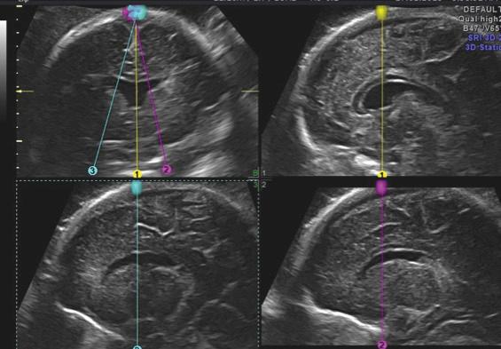 • Fig. 28.27, Fusion of the anterior horns and absence of the septum pellucidum has been observed as an isolated finding in association with optic atrophy in septo-optic dysplasia and in the presence of lobar holoprosencephaly.