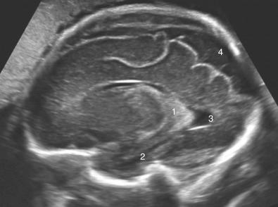 • Fig. 28.5, Parasagittal scanning plane allows the evaluation of the lateral ventricle including the temporal horn. In addition, some information on the cerebral gyration is visualised: the (1) choroid plexus, (2) temporal horn of the lateral ventricle, (3) posterior horn and (4) subarachnoid space.