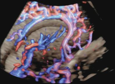 • Fig. 28.6, Colour Doppler flow of the cerebral vascularisation is particularly helpful in the identification of normal vascularisation and the presence of arteriovenous malformations. This image reveals the details of the pericallosal arterial supply.