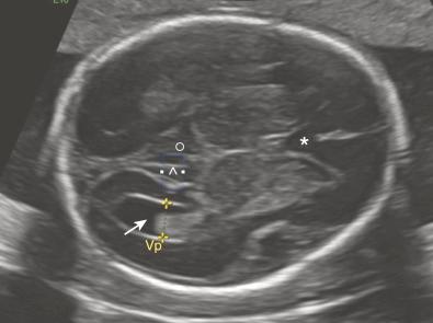 • Fig. 28.8, Measurement of the lateral ventricle (Vp) should be standardised to incorporate the following structures: the cavum septi pellucidi ( asterisk ), the ambient cistern (°) and the atrium of the lateral ventricle ( arrow ). Measurement is preformed from the inner to the outer border at the level of the sulcus parieto-occipitalis medialis ( ^ ), comparable with the technique of nuchal translucency evaluation in the first trimester.