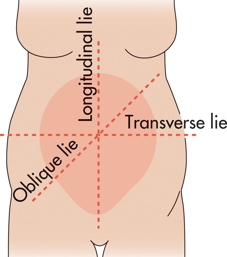 Fig. 51.1, Vectors demonstrating the three major possible axes that a fetus may occupy. Fetal lie does not necessarily indicate whether the vertex or the breech is closest to the cervix.