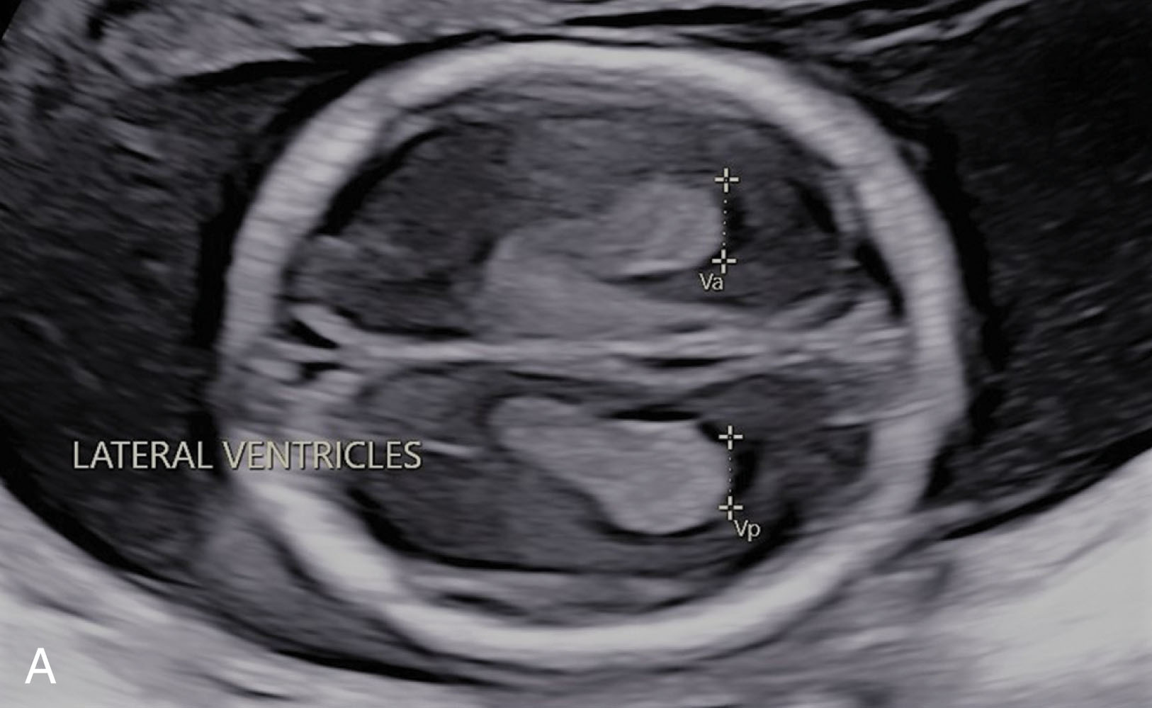 Fig. 51.12, (A) Transverse view at the level of the ventricles. The width of the lateral ventricle is measured from medial to lateral edges. (B) Transverse view slightly inferior to the level of the ventricles, near the thalamus (hypoechoic “heart” structure in the center of the skull). This is the level at which the biparietal diameter and head circumference are measured. (C) Transverse view inferior to the level of part B; the posterior fossa is seen at this level with the cerebellum (CB), cisterna magna (CM), and the nuchal fold (NF) demonstrated.