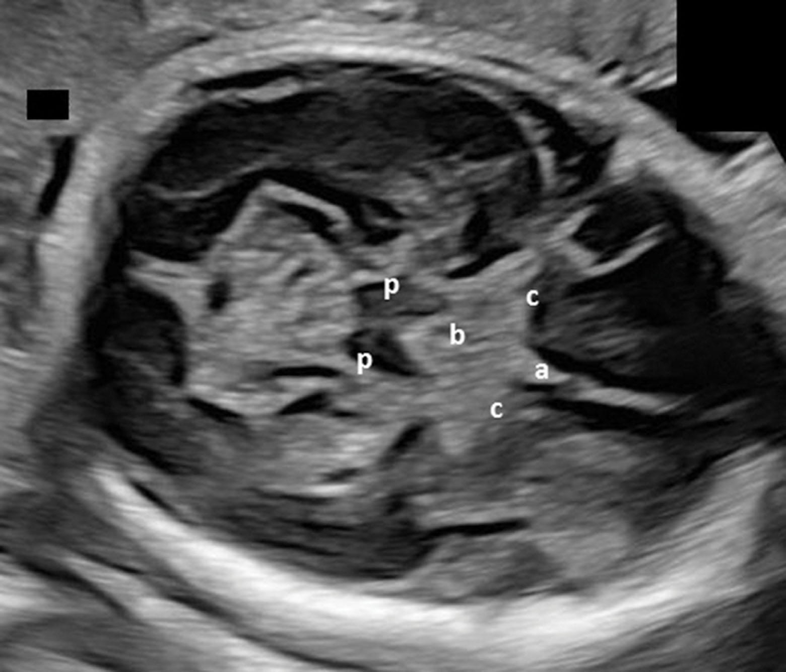 Fig. 51.13, Circle of Willis (c) identified anterior to the cerebral peduncles (p). Arterial pulsations may be observed from the basilar artery (b) and the anterior cerebral artery (a) in real-time imaging. The middle cerebral artery pulsations may be seen at the lateral margins of the circle of Willis.